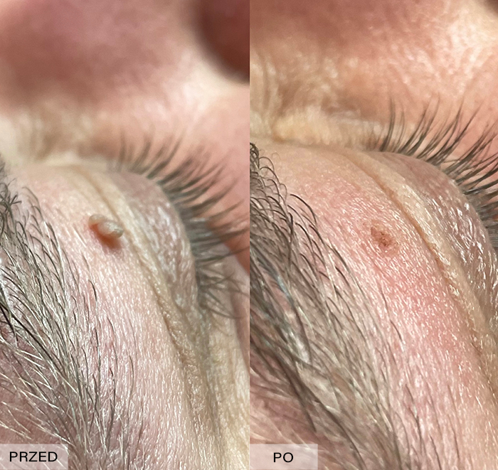 Efekt elektrokoagulacji